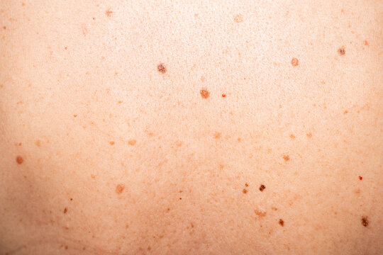 Natural Human Skin with Freckles and Moles