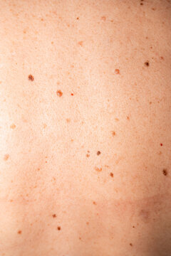 Natural Human Skin with Freckles and Moles