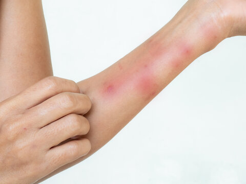 Hand with urticaria allergy itchy rash eczema itch woman from food,grass,air poisoning,cosmetic,health,body care disease lilness air,dissease medicine calamine Lotion Treatment ,infection pain scratch