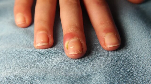 Closeup of acute paronychia on a fingernail with redness, swelling, and pus near the cuticle. Clinical detail highlights infection signs for medical education, dermatology references and healthcare.