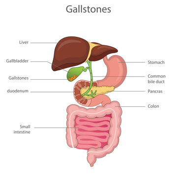 Gallstones in Gallbladder Anatomy Vector Illustration of Human Digestive System