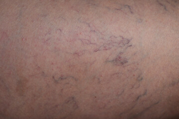 Fototapeta premium A close-up view of a leg skin fragment with varicose veins.