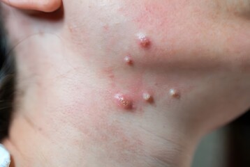 Fototapeta premium Close up of inflammatory acne pustules and cystic breakouts on woman's jawline neck