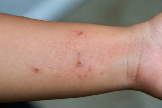 Close up of skin rash with small blisters and crusting on human forearm.