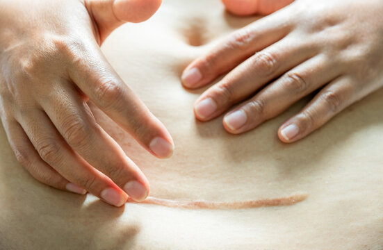 Close-up of a healed C-section scar on a woman's belly with a hand gently touching the skin. Concept of postpartum body reality, maternal healthcare, and the strength of motherhood