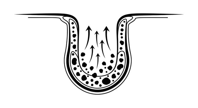 An anatomical illustration of a skin pore or cavity with particles and upward arrows indicating expulsion.