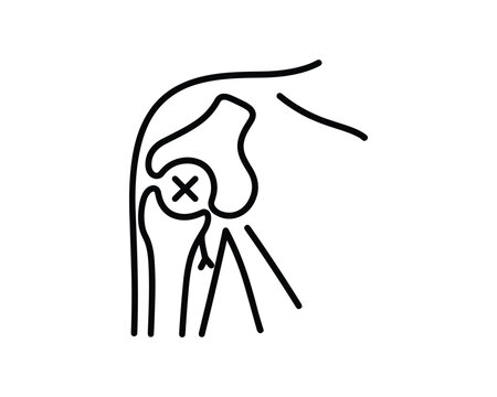 Shoulder joint dislocation anatomical illustration, medical diagram with injured shoulder joint.