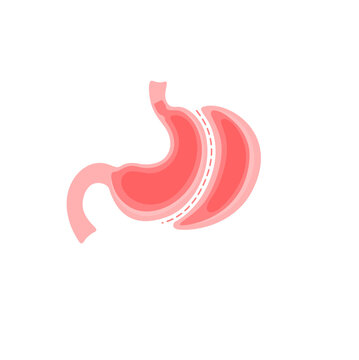 Vertical sleeve gastrectomy surgery medical vector Illustration 