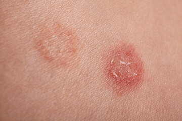 Fototapeta premium Closeup Inflamed Skin Lesions Showing Scab, Redness, Patient Torso Patch With Surrounding Lighter Discoloration, Moist Crust And Rough Texture, Clinical Dermatology, Epidermal Detail, Derma