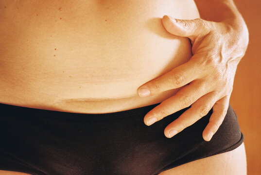 Woman Hand on Stomach with c-section scar. Film