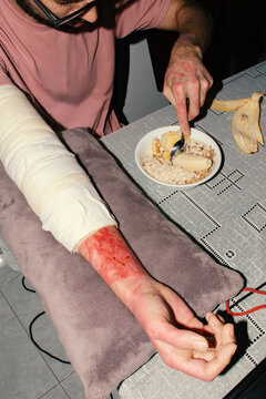 Wounded person eating with bandaged arm at home