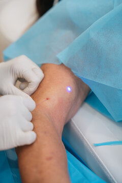 Doctor performing laser vein removal procedure on patient arm
