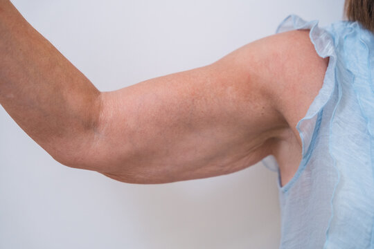 Woman's arm showing loose saggy skin