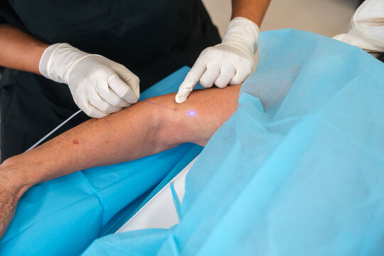 Endolaser treatment on the arm to tighten the skin and firmness