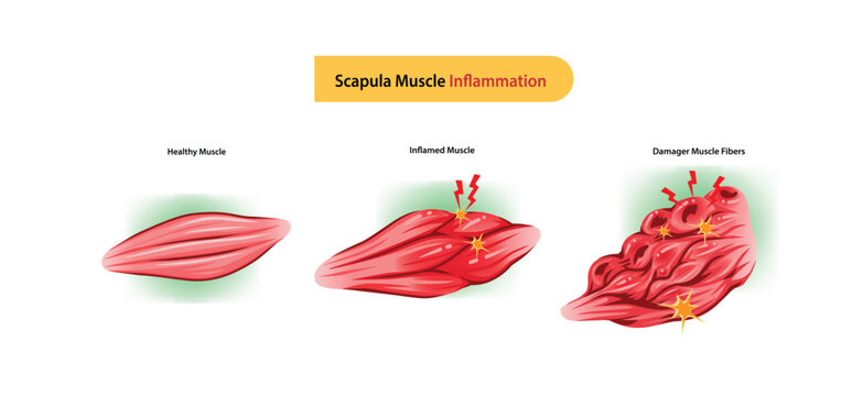 Comparison of healthy, inflamed, and damaged scapula muscle fibers showing progression of muscle inflammation and injury.