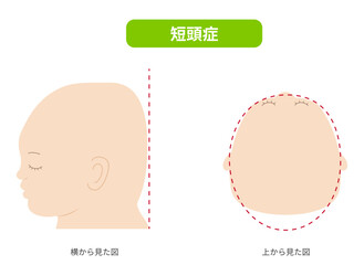 横と真上から見た頭の形に歪みがある斜頭症,短頭症,長頭症の赤ちゃんのイラスト
