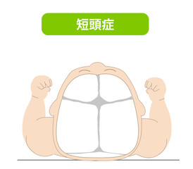 赤ちゃんが寝ている頭の向きによって頭の形に歪みが生じるメカニズム、斜頭症,短頭症,長頭症の赤ちゃんのイラスト