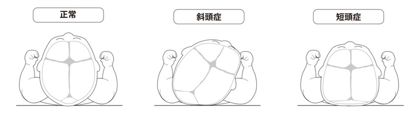 白黒線画　赤ちゃんが寝ている頭の向きによって頭の形に歪みが生じるメカニズム、斜頭症,短頭症,長頭症の赤ちゃんのイラスト