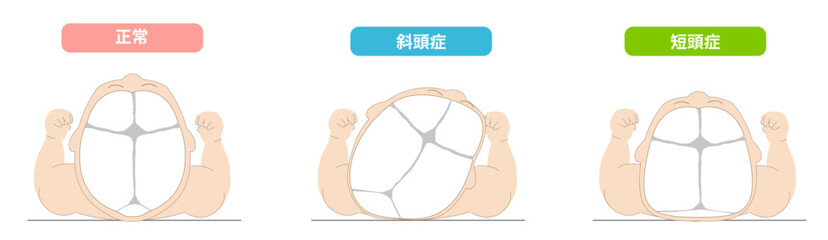 赤ちゃんが寝ている頭の向きによって頭の形に歪みが生じるメカニズム、斜頭症,短頭症,長頭症の赤ちゃんのイラスト
