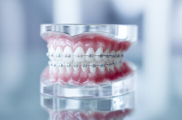 歯列矯正ワイヤー装着の歯モデル｜矯正歯科