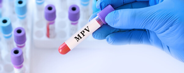 Obraz premium Doctor holding blood sample tube for MPV test assessing mean platelet volume to evaluate platelet size, clotting function and potential cardiovascular or inflammatory disorders