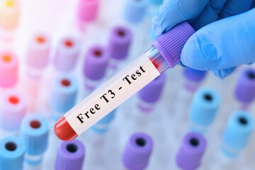 Fototapeta premium Doctor holding free T3 blood test tube explaining evaluation of active thyroid hormone levels, metabolism regulation and diagnosis of thyroid function disorders in clinical laboratory diagnostics