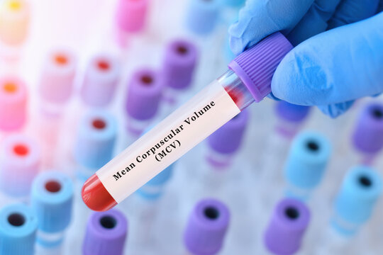 Doctor holding blood sample tube with MCV test, mean corpuscular volume analysis explaining red blood cell size for anemia detection, blood disorders diagnosis and complete blood count interpretation