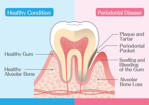 Periodontal Disease Diagram, Healthy vs Gum Disease Comparison Illustration