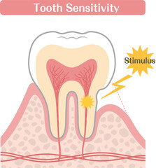 Tooth Sensitivity Diagram, Dentin Exposure and Nerve Stimulation Illustration