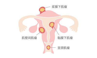 Fototapeta premium 子宫肌瘤类型图解 – 肌壁间肌瘤、黏膜下肌瘤、浆膜下肌瘤、宫颈肌瘤