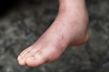 Swollen Foot After Cast Removal of Metatarsal Fracture