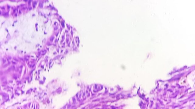 Tissue from left auricle. Carcinoma in situ with microinvasion. Histopathology microscopic image. 