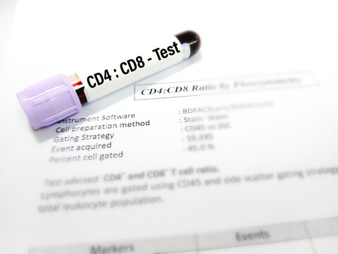 Blood sample for CD4, CD8 ratio test (Immunity cell in HIV patient). A medical testing concept with test report background.