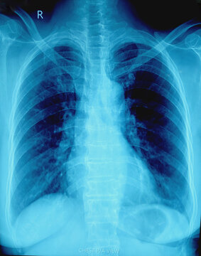 X-ray of human chest. Suggestive of pneumonitis.