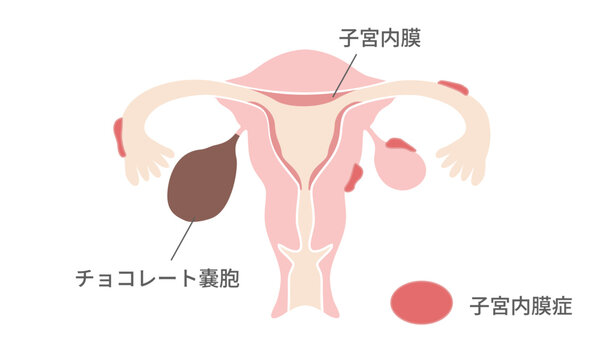 子宮内膜症とチョコレート嚢胞の図解 &ndash; 発生部位と構造の違い
