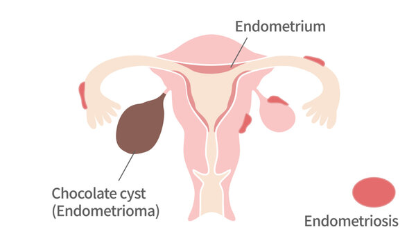 Medical Illustration of Endometriosis and Chocolate Cyst &ndash; Female Reproductive System