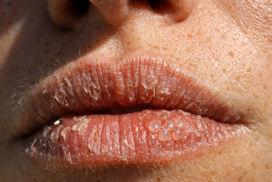 Close-up of lips showing dryness, cracking, and clustered fluid-filled blisters on lower lip, characteristic of herpes simplex virus outbreak. Medical representation highlights cold sore symptoms.