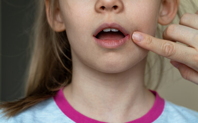 Close up of mothers hand applies ointment to mouth of child with angular stomatitis. Girls face with perleche. Angulit. Disease illness. Medicine. Healthcare