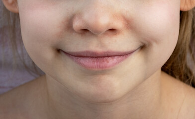 Fototapeta premium Close up of childs face with weathered skin and chapped lips. Sensitive skin to wind and cold weather. Atopic dermatitis. Baby skin care. Medicine. Healthcare