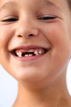 Child With Missing Teeth Smiles Brightly