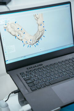Laptop displaying 3d dental scan for orthodontics planning