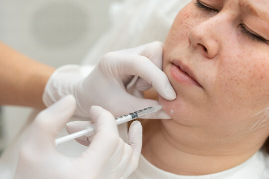 Close-up of aesthetic chin injection procedure  
