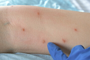 Fototapeta premium Doctor examining child with bodily red rash. Kid allergy closeup. Teen girl scratches an eruption, atopic skin. Irritation, hive. Pruritus. Mosquito flea insect bite. Sunburn, Seborrheic Dermatitis