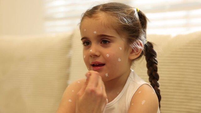 Mother applying cream onto skin of her daughter with chickenpox at home, closeup