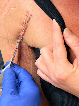 Medical staple Removal from Surgery Incision