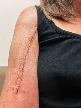 Detail of Surgery Scar on Arm and Shoulder