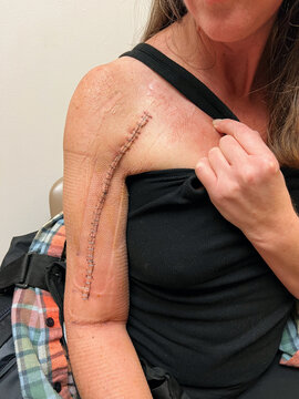 Post Surgery Scar with Medical Staples