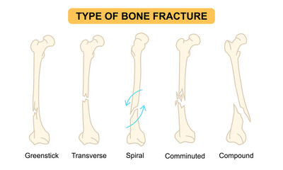 Fototapeta premium Medical Illustration of Type of Bone Fracture, greenstick, transverse, spiral, comminuted, compound, osteoporosis bone. flat vector illustration for medical, poster and education.