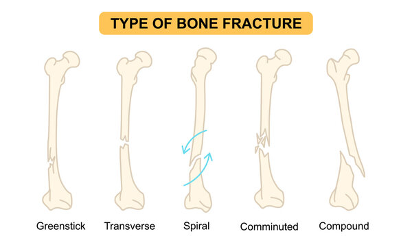 Medical Illustration of Type of Bone Fracture, greenstick, transverse, spiral, comminuted, compound, osteoporosis bone. flat vector illustration for medical, poster and education.