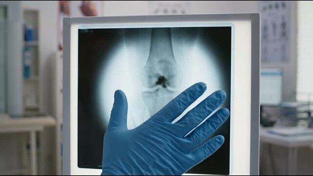 Gloved hand medical doctor examining looking x ray scan fracture clinic hospital healthcare diagnostic radiology orthopedic injury bone skeleton arm wrist human anatomy treatment analysis checkup